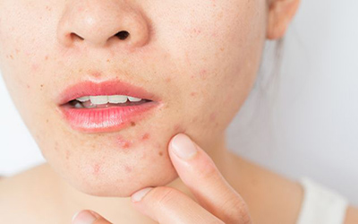dermatologia acne cicatrices queloides laser dermatologo psoriasis tratamiento dermatologico dermatologa lleida dermatologo lleida cicatriz con queloide
