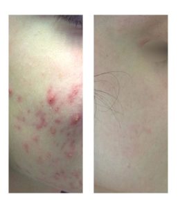 acne acne facial cicatrices dermatologa lleida dermatologo lleida servicios dermatologicos