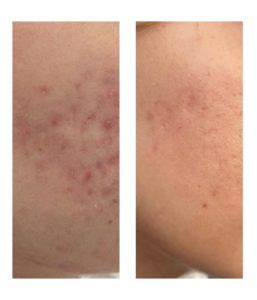 acne acne facial cicatrices dermatologa lleida dermatologo lleida servicios dermatologicos