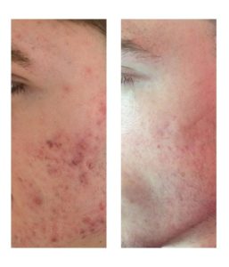 acne acne facial cicatrices dermatologa lleida dermatologo lleida servicios dermatologicos