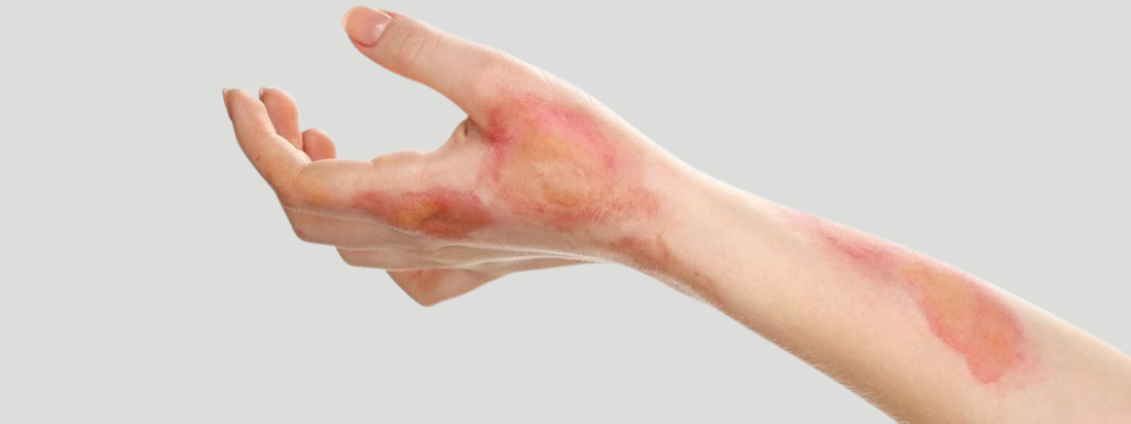 cicatrices queloides acne laser dermatologa lleida