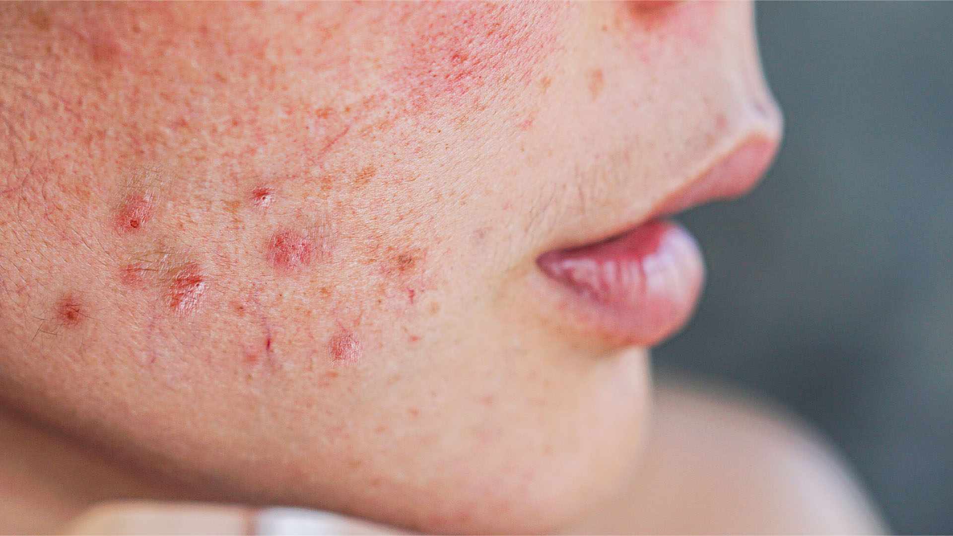 dermatologia acne cicatrices queloides laser dermatologo psoriasis tratamiento dermatologico dermatologa lleida dermatologo lleida cicatriz con queloide granos en la cara
