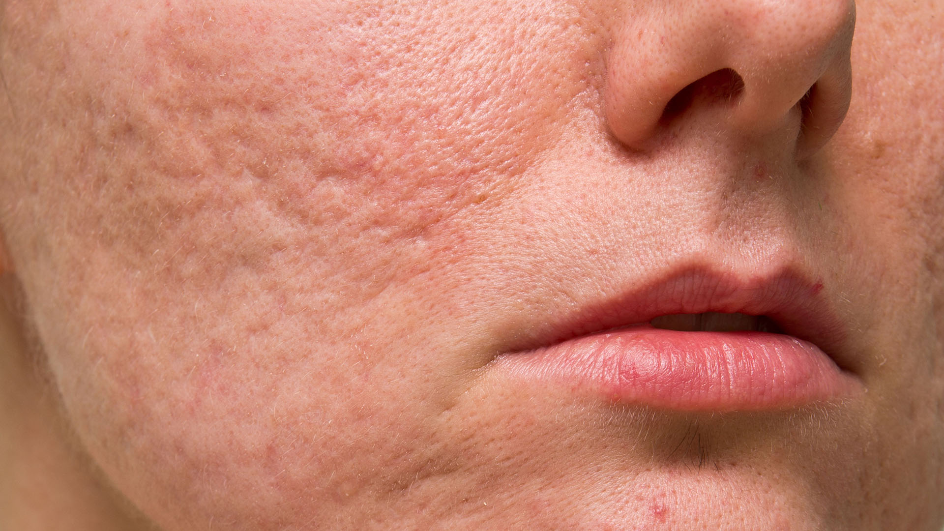 acne facial acne cicatrices queloides dermatologa lleida dermatologo lleida dermatologia laser